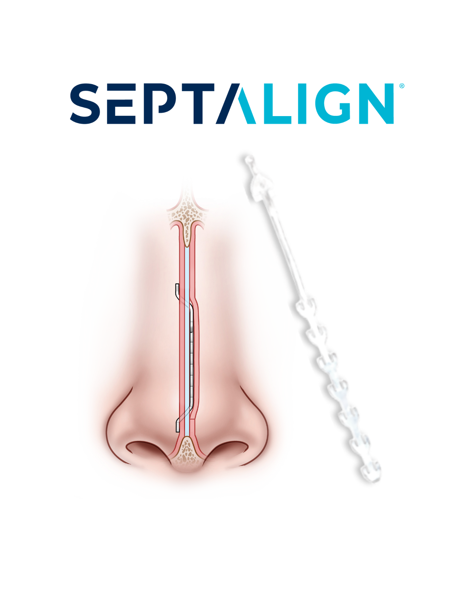 Spirair publishes six-month Vayu Study data for SeptAlign implant