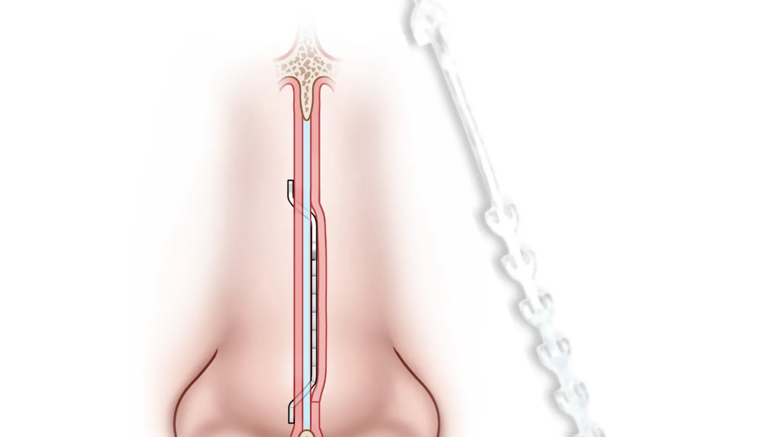 Spirair publishes six-month Vayu Study data for SeptAlign implant