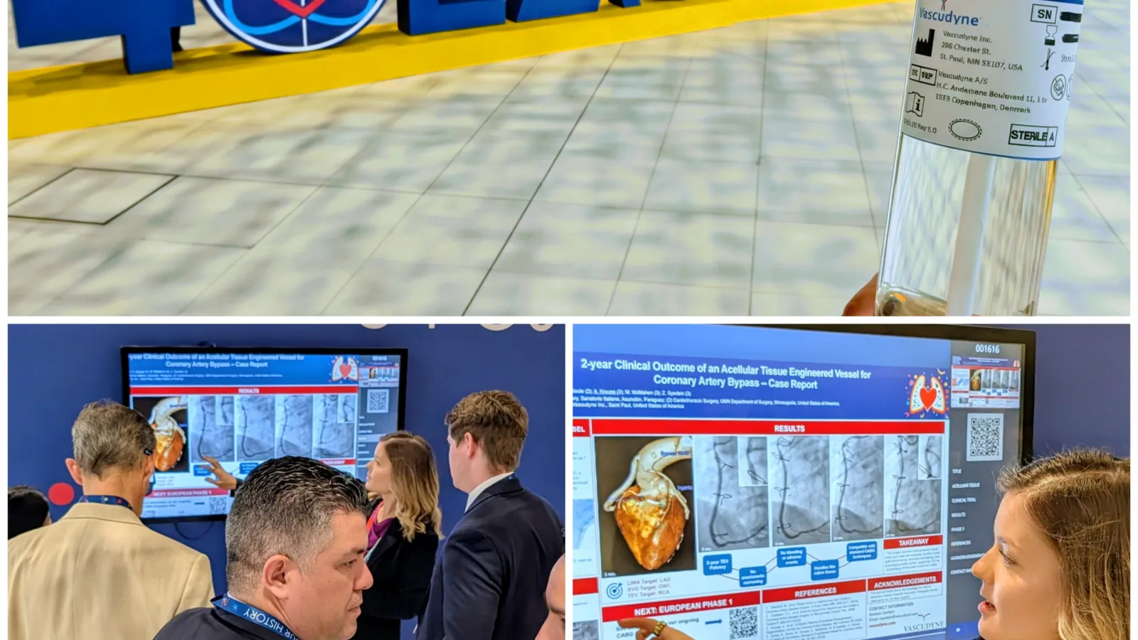 Vascudyne lab-grown bypass vessel sustains flow at two-year mark